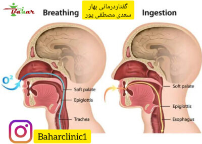 اختلال بلع